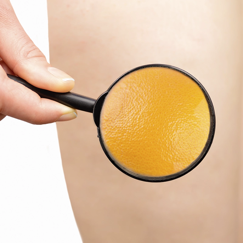 La celulitis se ve como piel de naranja